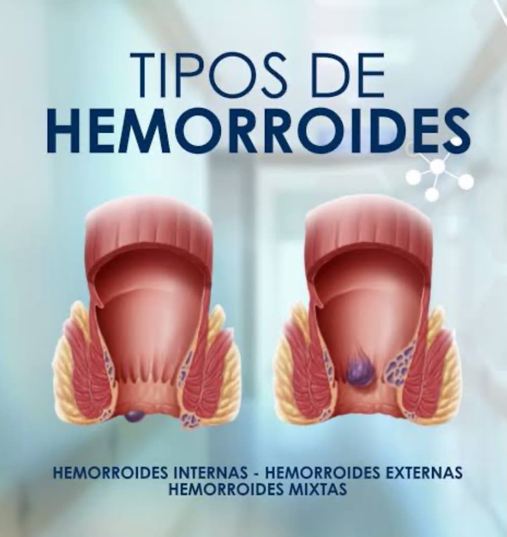 Ilustración médica de los tipos de hemorroides: internas, externas y mixtas